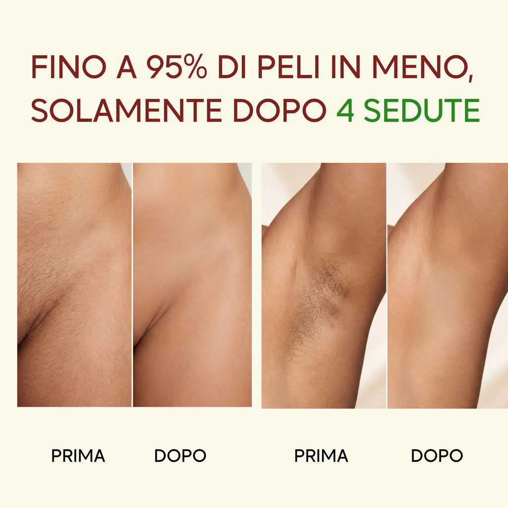 Glowin IPL - Epilatore a Luce Pulsata