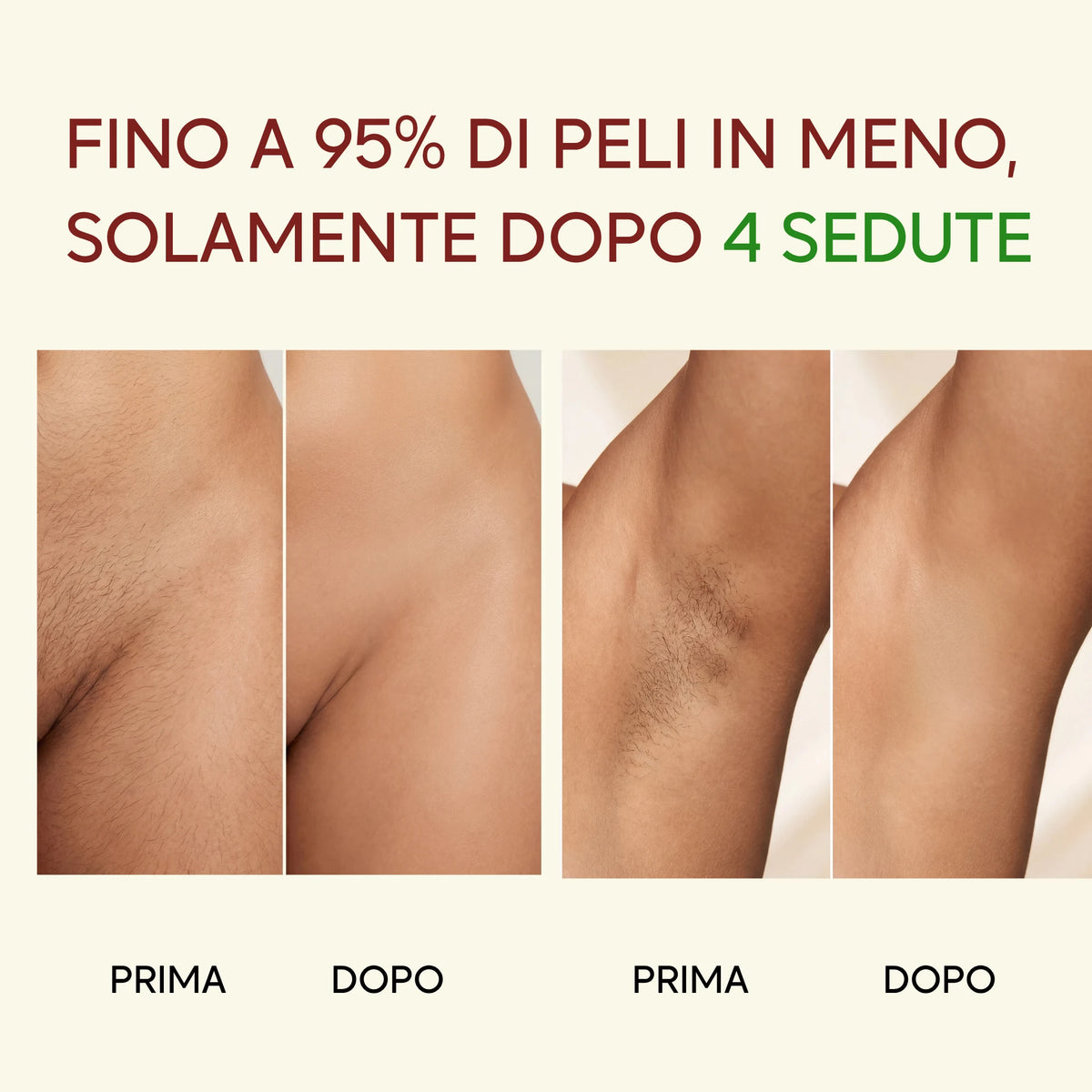 Glowin IPL - Epilatore a Luce Pulsata